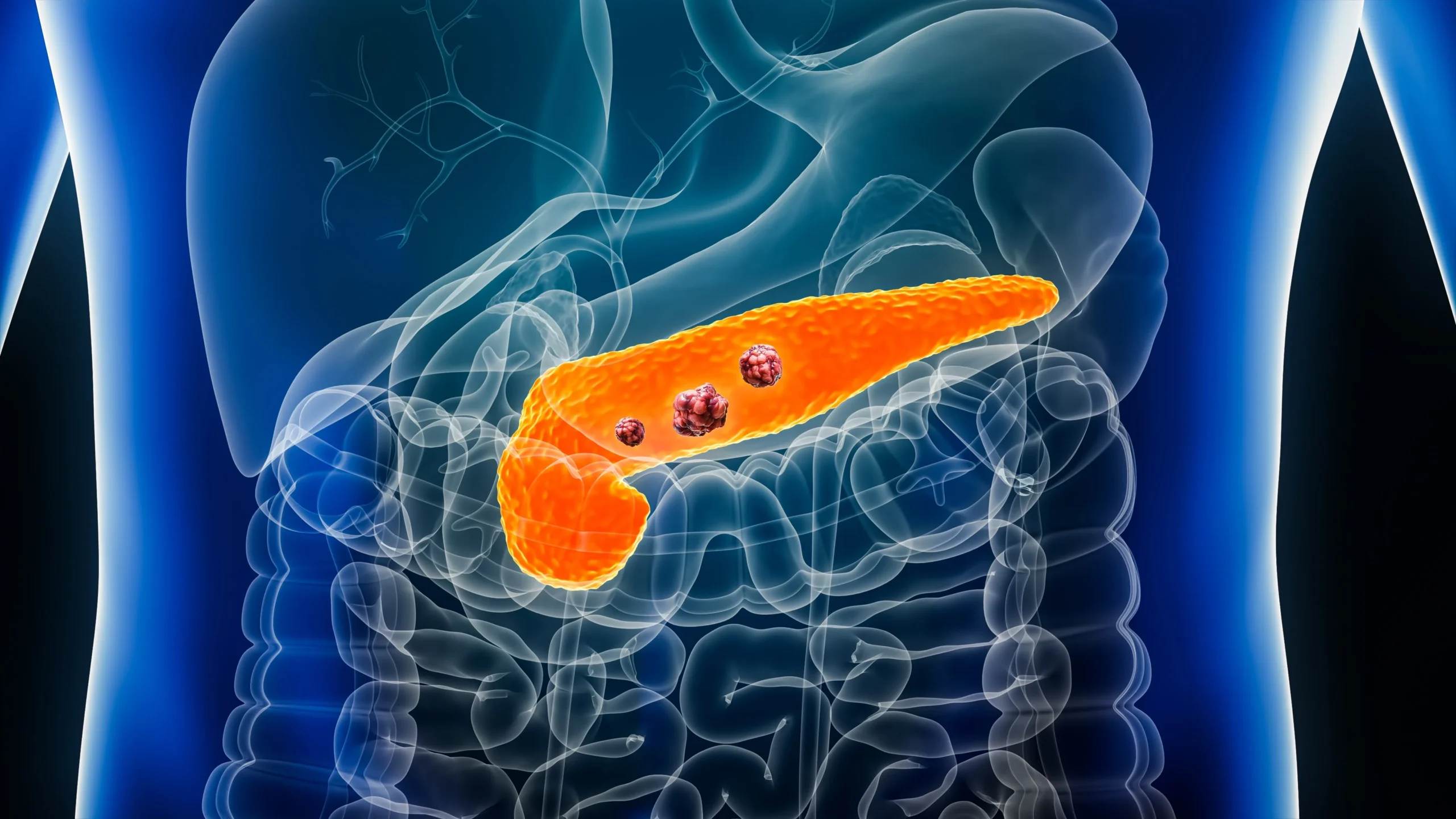 Tumoră pancreatică